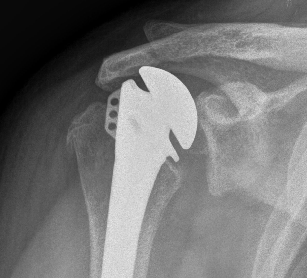 Shoulder Hemiarthroplasty Rotator Cuff Failure